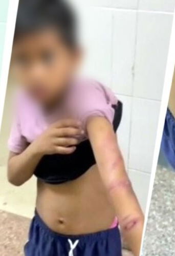 जमशेदपुर: ट्यूशन टीचर की हैवानियत, कम नंबर आने पर भाई-बहन को पीटा; बच्ची की उंगली फ्रैक्चर