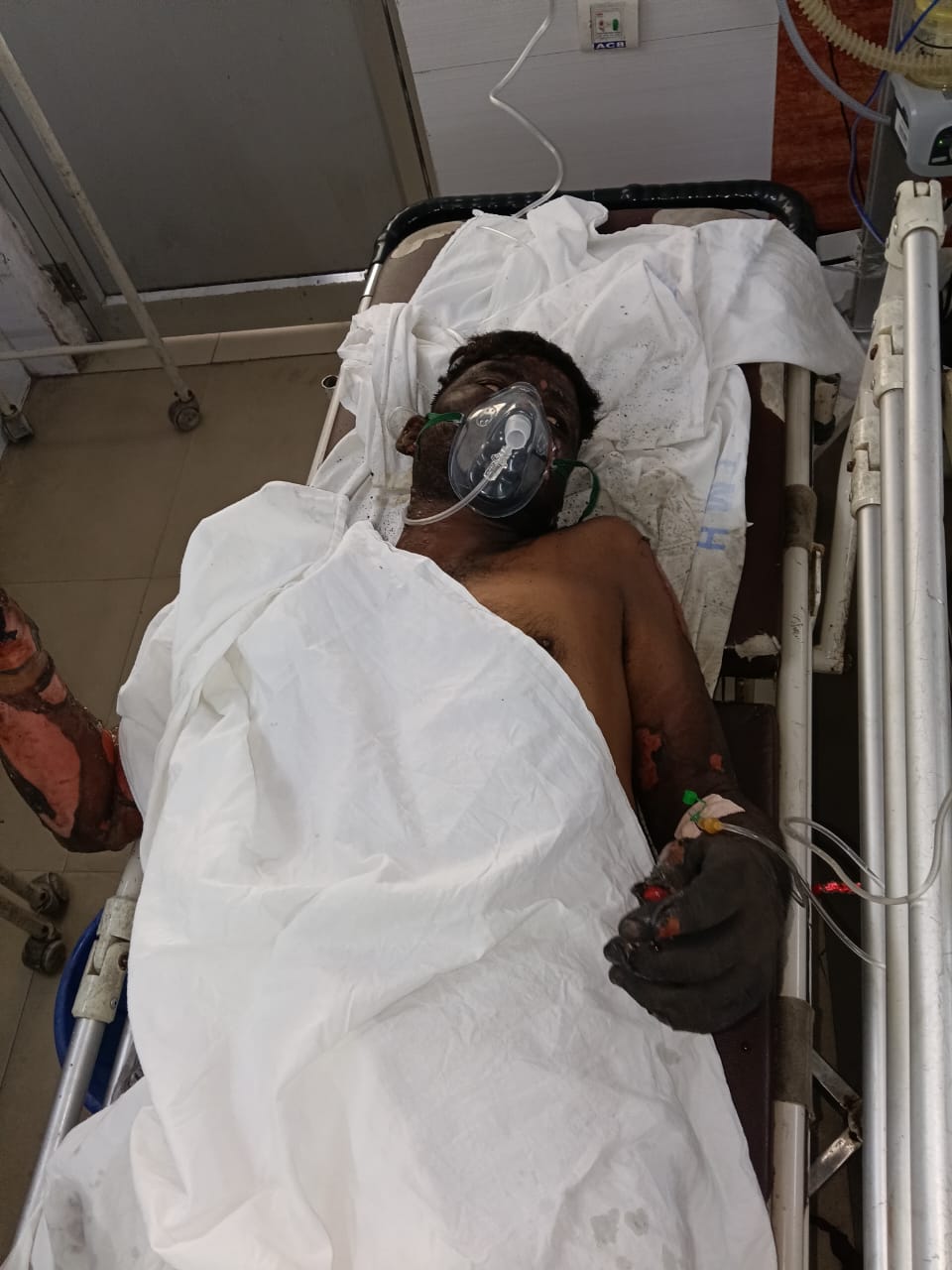 Saraikela News : चांडिल में गैलेक्सी इंगोट प्लांट के फर्नेस में विस्फोट, दो कर्मी झुलसे, हालत गंभीर