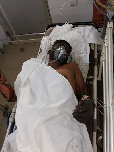 Saraikela News : चांडिल में गैलेक्सी इंगोट प्लांट के फर्नेस में विस्फोट, दो कर्मी झुलसे, हालत गंभीर