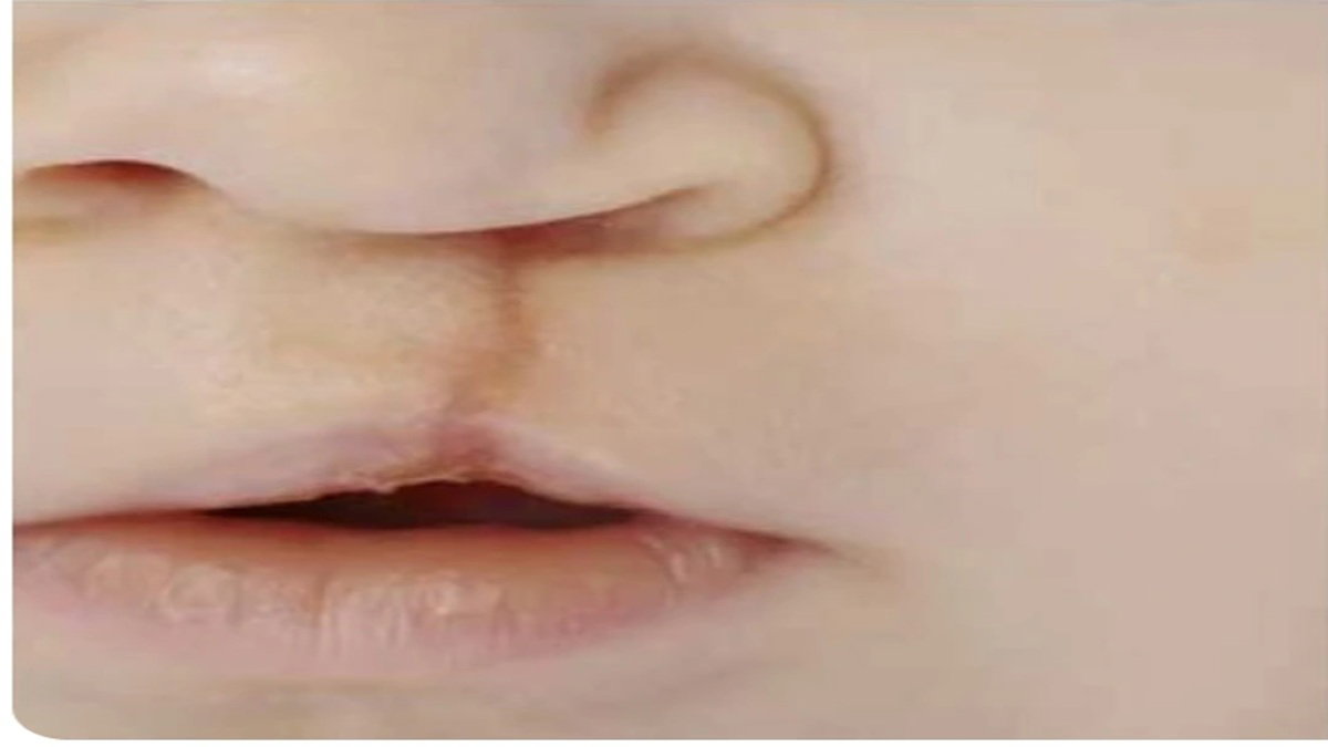 Cleft lip surgery