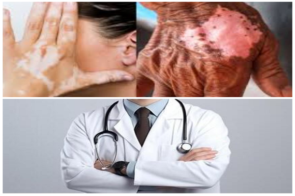 रांची: कुष्ठ रोगियों के प्रति भेदभाव खत्म करने के लिए कार्यशाला