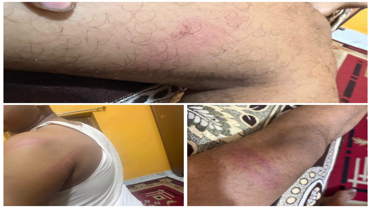 Injury marks on body