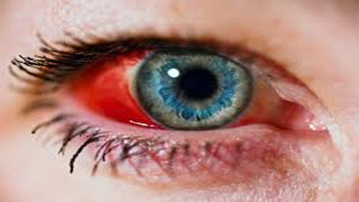 retinal hemorrhage