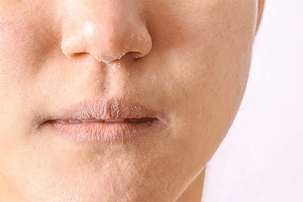 बदलते मौसम में स्किन के रूखेपन से हैं परेशान तो अपनाएं ये आसान टिप्स