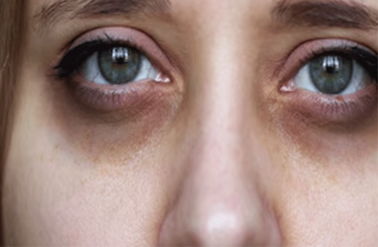 डार्क सर्कल्स से हैं परेशान  तो अपनाए ये घरेलू उपाए