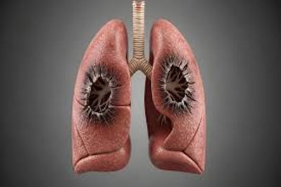 CMO ने DC से सिलिकोसिस पीड़ितों की रिपोर्ट 15 दिनों में मांगी, 10 महीने में भी नहीं मिली